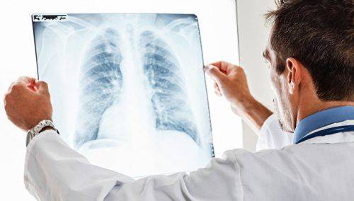 Як зрозуміти чи заразився ти туберкульозом?